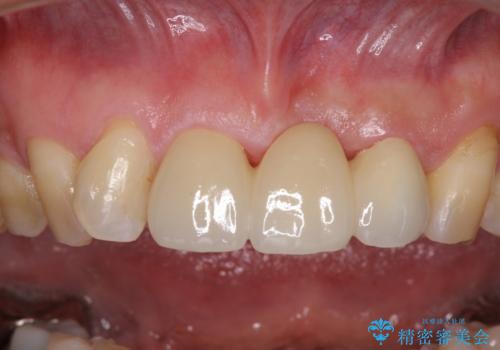 不自然な前歯のブリッジをオールセラミックできれいにの治療後