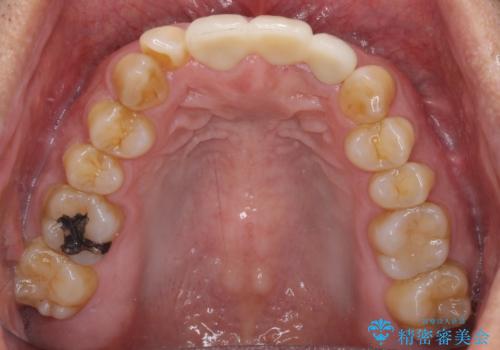 不自然な前歯のブリッジをオールセラミックできれいにの治療後
