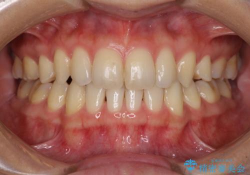 抜歯矯正の後戻りによるすきっ歯をインビザラインでの症例 治療後