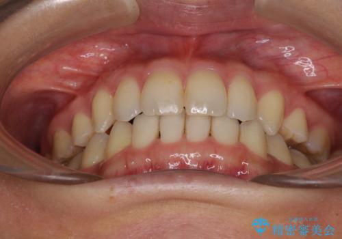 抜歯矯正の後戻りによるすきっ歯をインビザラインでの治療後