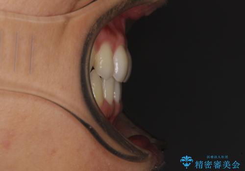 抜歯矯正の後戻りによるすきっ歯をインビザラインでの治療後