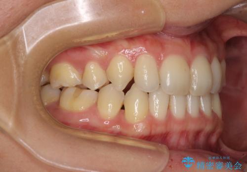 抜歯矯正の後戻りによるすきっ歯をインビザラインでの治療後