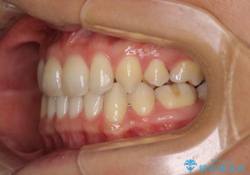 抜歯矯正の後戻りによるすきっ歯をインビザラインでの治療後