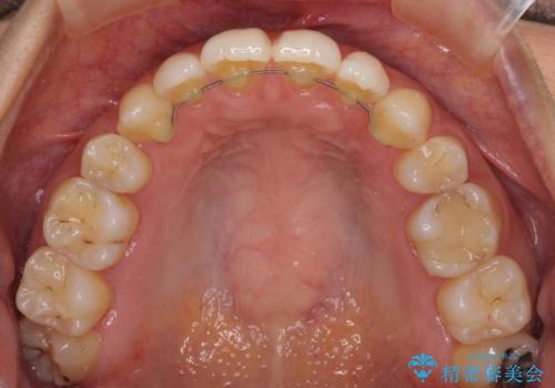 抜歯矯正の後戻りによるすきっ歯をインビザラインでの治療後