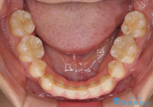 抜歯矯正の後戻りによるすきっ歯をインビザラインでの治療後