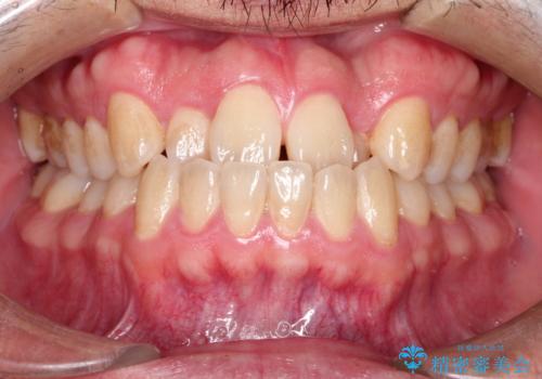 前歯が反対にかんでいる　インビザラインとワイヤーを組み合わせた矯正治療の症例 治療前