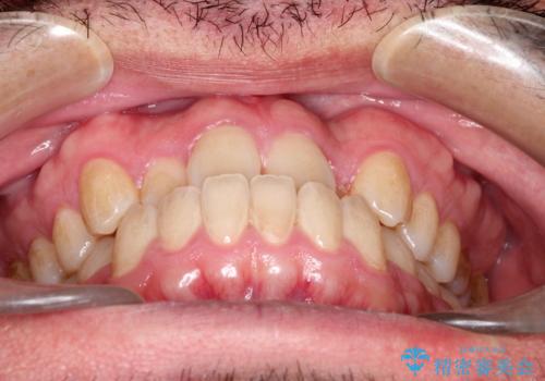 前歯が反対にかんでいる インビザラインとワイヤーを組み合わせた矯正治療の治療前