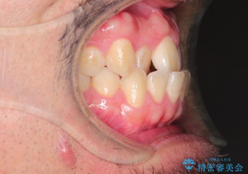 前歯が反対にかんでいる インビザラインとワイヤーを組み合わせた矯正治療の治療前
