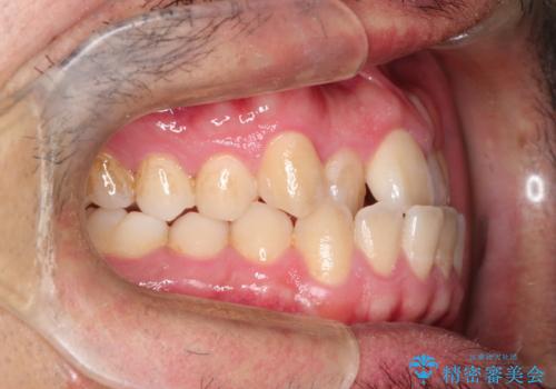 前歯が反対にかんでいる インビザラインとワイヤーを組み合わせた矯正治療の治療前