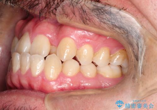 前歯が反対にかんでいる　インビザラインとワイヤーを組み合わせた矯正治療の治療前
