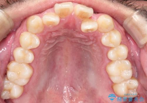 前歯が反対にかんでいる インビザラインとワイヤーを組み合わせた矯正治療の治療前