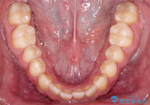 前歯が反対にかんでいる インビザラインとワイヤーを組み合わせた矯正治療の治療前