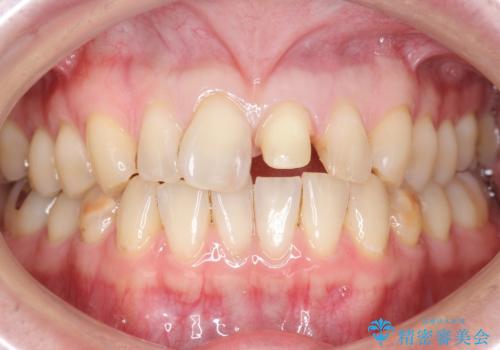 前歯のつめもの きれいにしたい 30代男性の治療中