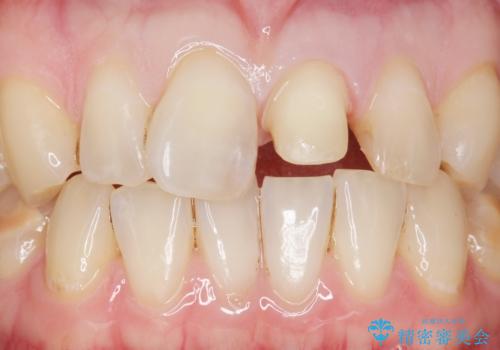前歯のつめもの きれいにしたい 30代男性の治療中