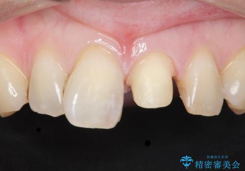 前歯のつめもの きれいにしたい 30代男性の治療中