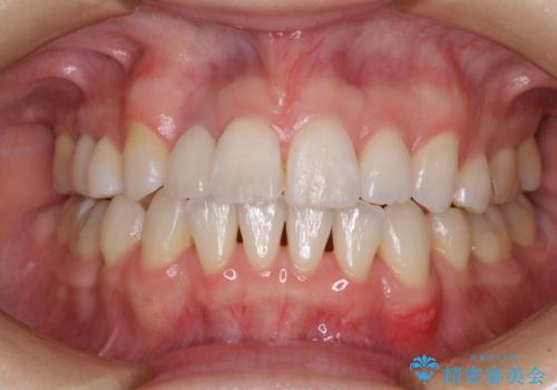 変色した前歯　オーダーメイドタイプのオールセラミッククラウンの治療後
