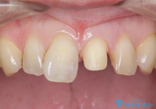 前歯のつめもの きれいにしたい 30代男性の治療中