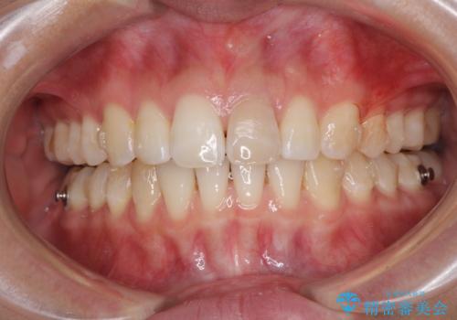 気になる前歯を治したい インビザライン矯正とオールセラミッククラウンの治療中