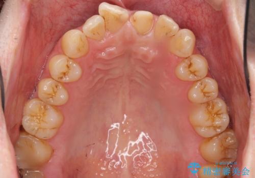 前歯のつめもの きれいにしたい 30代男性の治療中