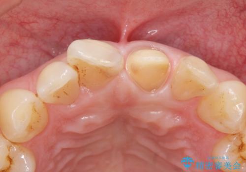 前歯のつめもの きれいにしたい 30代男性の治療中