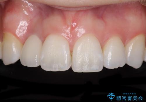 変色した前歯 オーダーメイドタイプのオールセラミッククラウン