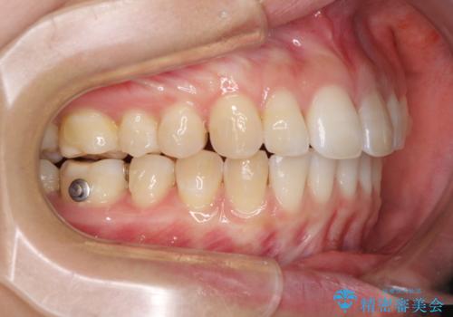 気になる前歯を治したい インビザライン矯正とオールセラミッククラウンの治療中