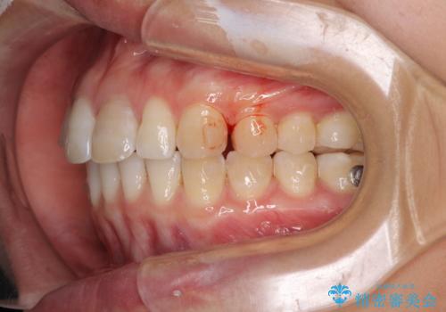 気になる前歯を治したい インビザライン矯正とオールセラミッククラウンの治療中