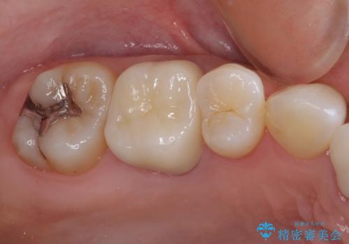 変色した前歯 オーダーメイドタイプのオールセラミッククラウンの治療後