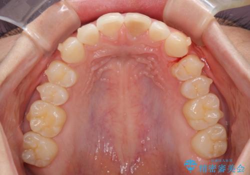 気になる前歯を治したい インビザライン矯正とオールセラミッククラウンの治療中