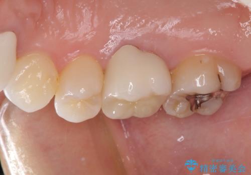 変色した前歯 オーダーメイドタイプのオールセラミッククラウンの治療後