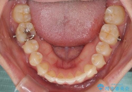 気になる前歯を治したい インビザライン矯正とオールセラミッククラウンの治療中
