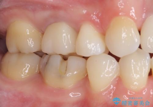 変色した前歯 オーダーメイドタイプのオールセラミッククラウンの治療後