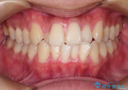 前歯のクロスバイトとガタつきをマウスピース矯正(インビザライン )で治療した症例の症例 治療前