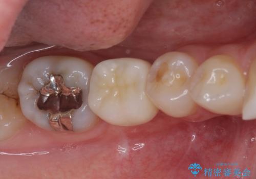 折れてしまった奥歯 下の奥歯のインプラント治療の症例 治療後