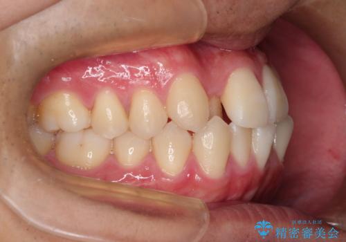 前歯のクロスバイトとガタつきをマウスピース矯正(インビザライン )で治療した症例の治療前