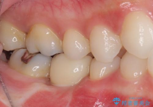 折れてしまった奥歯 下の奥歯のインプラント治療の治療後