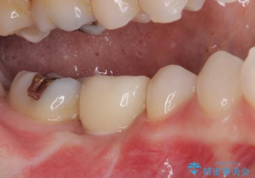 折れてしまった奥歯 下の奥歯のインプラント治療の治療後