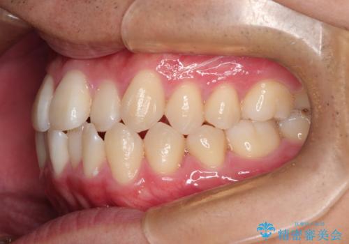 前歯のクロスバイトとガタつきをマウスピース矯正(インビザライン )で治療した症例の治療前