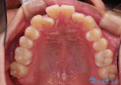 前歯のクロスバイトとガタつきをマウスピース矯正(インビザライン )で治療した症例の治療前