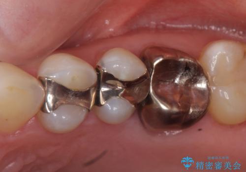 オールセラミッククラウン　セラミックインレー　銀歯を白い歯への症例 治療前