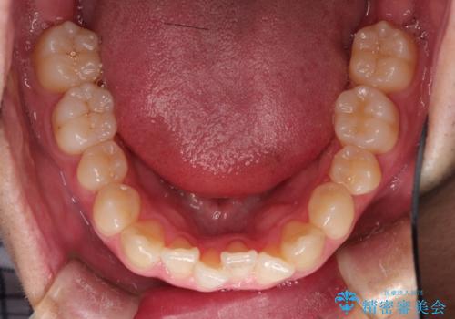 前歯のクロスバイトとガタつきをマウスピース矯正(インビザライン )で治療した症例の治療前