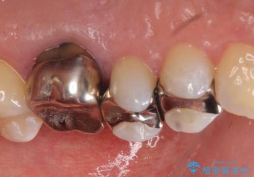 オールセラミッククラウン セラミックインレー 銀歯を白い歯への治療前