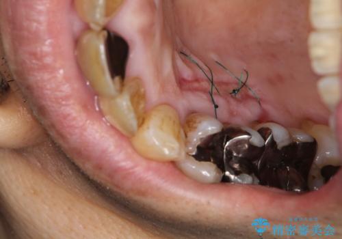 徐々に下がってきた歯肉へ再生療法(歯冠側移動術と結合組織移植術の併用)を施術し、丈夫な歯肉を獲得させた症例の治療後