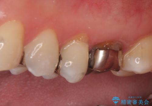 オールセラミッククラウン セラミックインレー 銀歯を白い歯への治療前