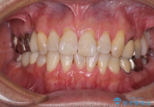 折れてしまった奥歯 インプラントによる補綴治療の治療後