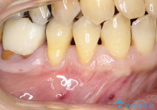 徐々に下がってきた歯肉へ再生療法(歯冠側移動術と結合組織移植術の併用)を施術し、丈夫な歯肉を獲得させた症例の治療前