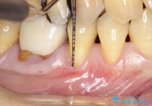 徐々に下がってきた歯肉へ再生療法(歯冠側移動術と結合組織移植術の併用)を施術し、丈夫な歯肉を獲得させた症例の治療前