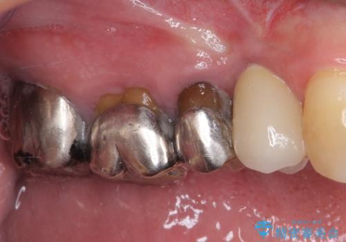 折れてしまった奥歯 インプラントによる補綴治療の治療後