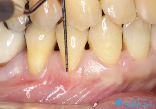 徐々に下がってきた歯肉へ再生療法(歯冠側移動術と結合組織移植術の併用)を施術し、丈夫な歯肉を獲得させた症例の治療前