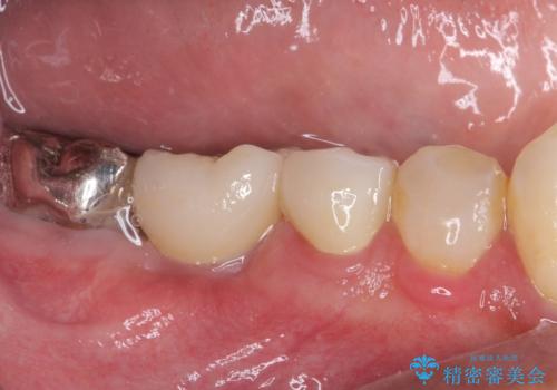 折れてしまった奥歯 インプラントによる補綴治療の治療後